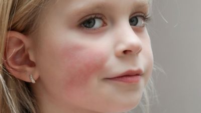 Beşinci hastalık, diğer adıyla Eritema enfeksiyozum, Parvovirüs B19 adlı bir