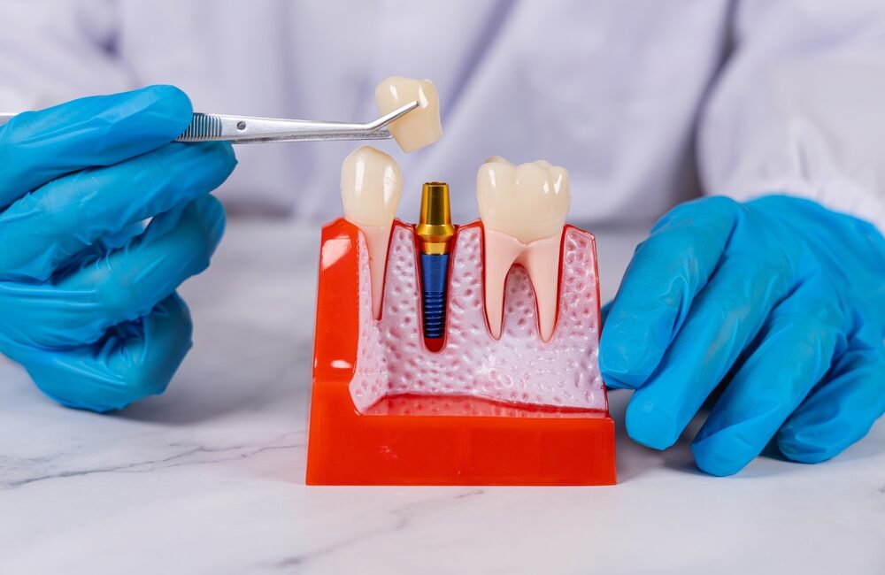 Diş implantları, doğal dişe en yakın çözümü sunmaları nedeniyle sabit