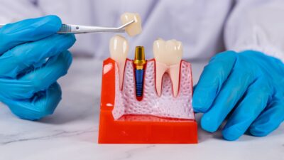 Diş implantları, doğal dişe en yakın çözümü sunmaları nedeniyle sabit
